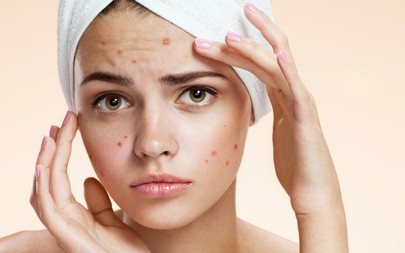 عليك تجنبها .. أطعمة تتسبب في ظهور حب الشباب