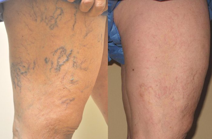 les varices نصائح الدكتورة أمنية بنكيران لتفادي ظهور الدوالي أو