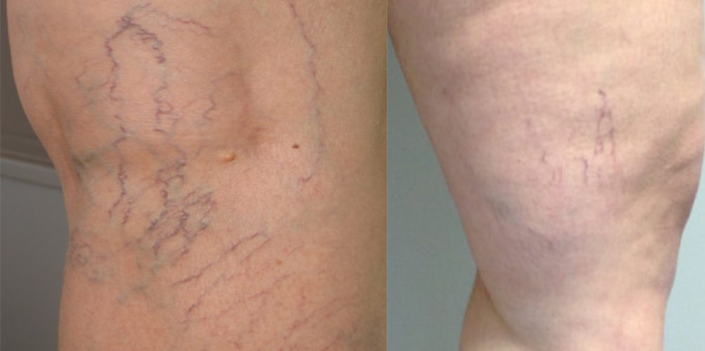 ما هي جلطة الأوردة (les varices ) و أسبابها مع الدكتورة أمنية بنكيران