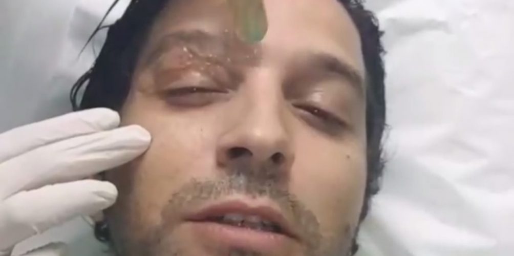 أنس الباز يخضع لجراحة تجميلية وهذه نصيحته للمغاربة (فيديو)