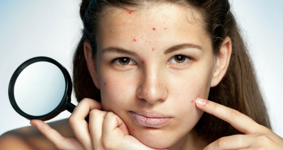 أسرع و أسهل الطرق للتخلص من الحبوب