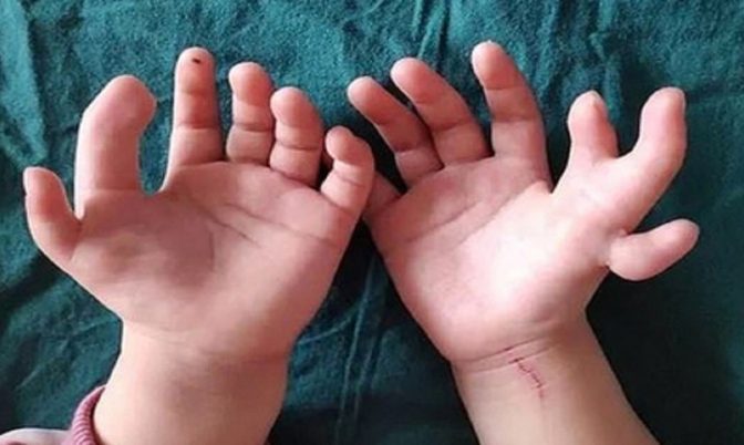 ولدت بـ 14 إصبعا.. أطباء ينجحون في إزالة أصابع زائدة لطفلة