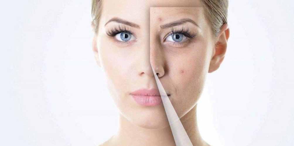 بينها البطاطا الحلوة والشاي الأخضر.. 5مواد غذائية لمكافحة حب الشباب