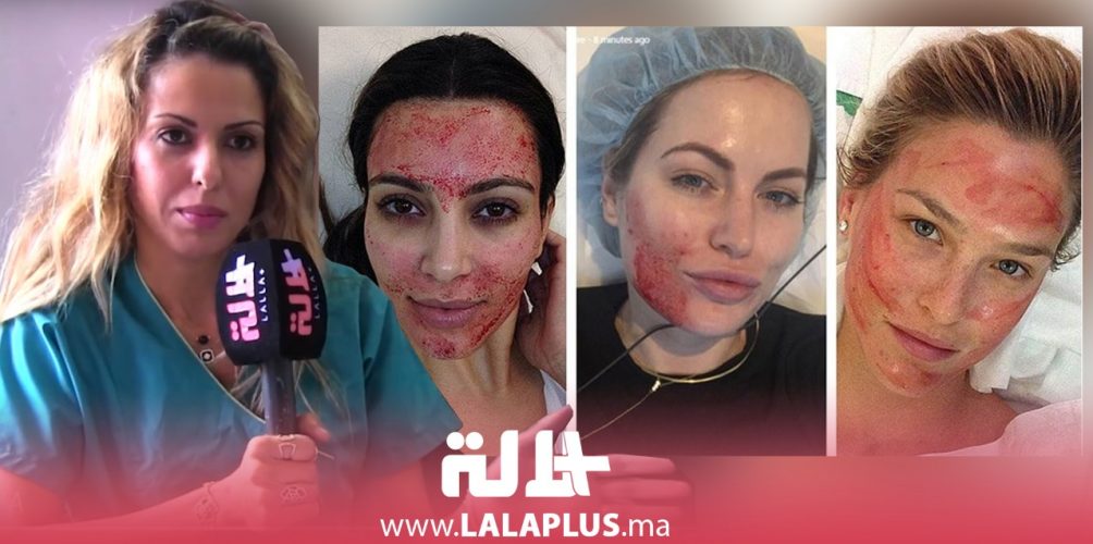 تمنع تساقط الشعر وتعيد للبشرة إشراقتها.. كل ما عليك معرفته عن تقنية الحقن بالبلازما (فيديو)