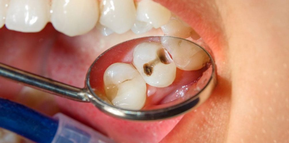 المشروبات الغازية سبب رئيسي لتآكل الأسنان