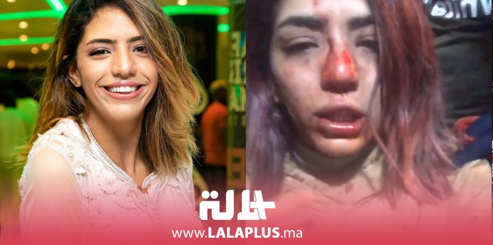 الصخيرات.. مغنية الراب « بسيكو كوين » تتعرض لاعتداء من مجهول (فيديو)