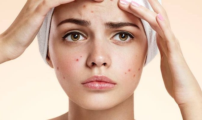 للتخلص نهائيا من حبوب الوجه.. عليك بخلطة زيت شجرة الشاي والالوفيرا