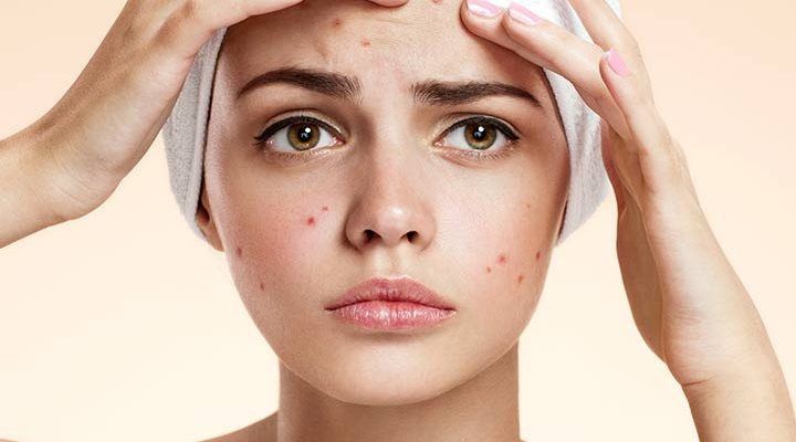 للتخلص نهائيا من حبوب الوجه.. عليك بخلطة زيت شجرة الشاي والالوفيرا