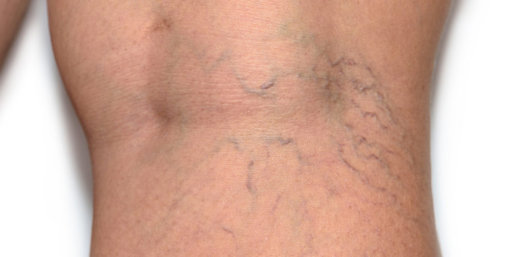 تعاني منها النساء أكثر من الرجال.. أسباب ظهور الأوردة العنكبوتية