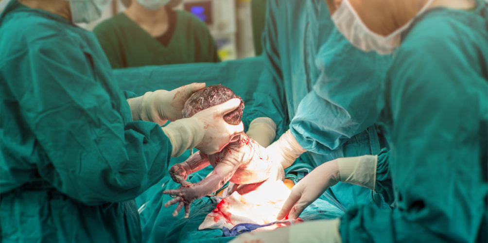 دراسة حديثة: مخاطر صحية أخرى للعملية القيصرية على الأطفال