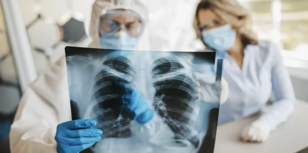 دراسة: كورونا يتسبب في تلف طويل المدى للرئة