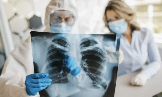 دراسة: كورونا يتسبب في تلف طويل المدى للرئة