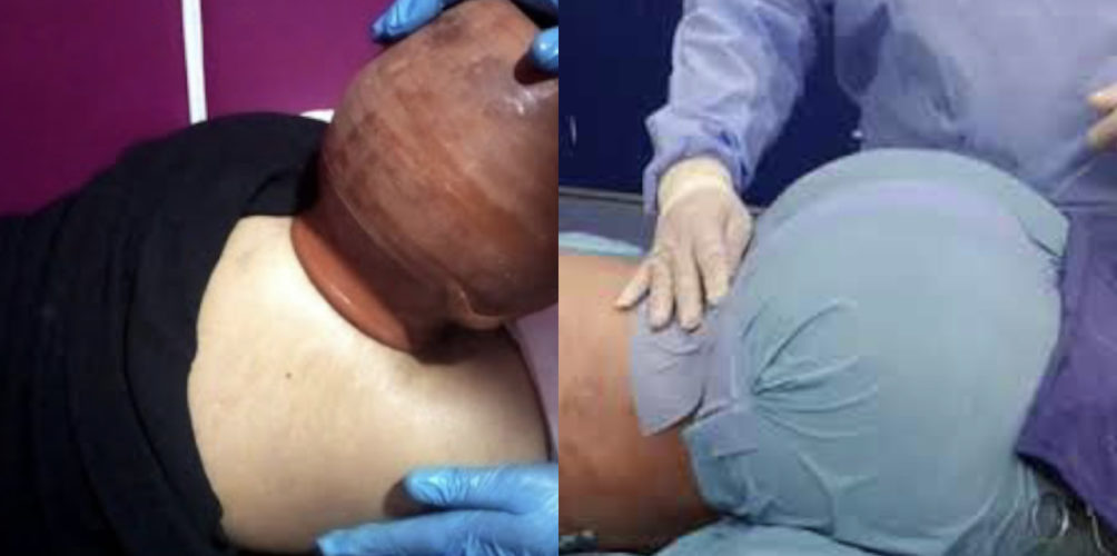 بين « الگلة » والوصفات الطبيعية والعمليات التجميلية.. هوس تكبير الأرداف بين بعض النساء