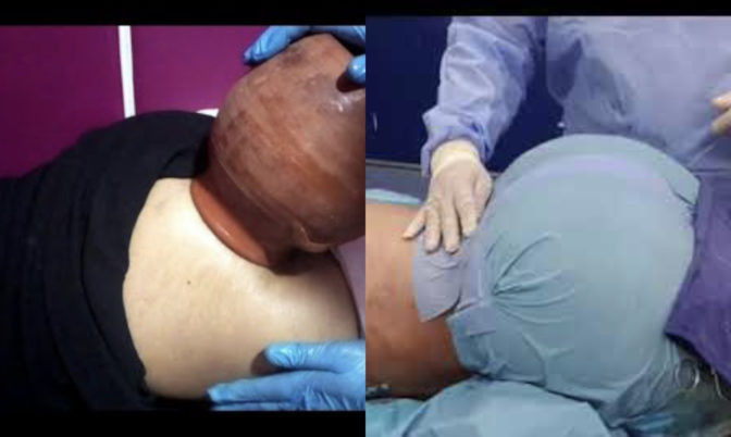 بين « الگلة » والوصفات الطبيعية والعمليات التجميلية.. هوس تكبير الأرداف بين بعض النساء