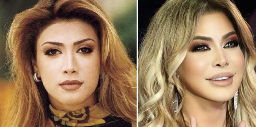 لأول مرة.. نوال الزغبي تكشف السبب وراء تشوه وجهها (فيديو)