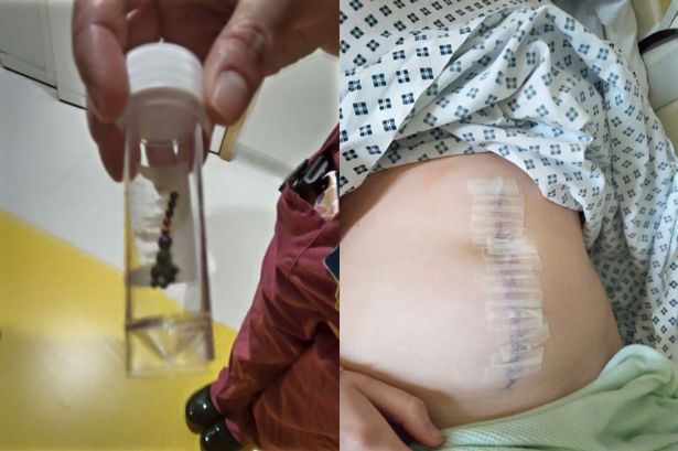 بسبب تحدٍ على « تيك توك ».. استئصال الزائدة الدودية وجزء من أمعاء طفلة