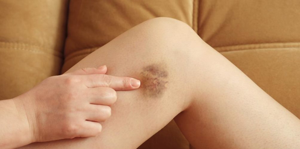 أسباب ظهور الكدمات على الجسم ومدى خطورتها.. أخصائي يشرح