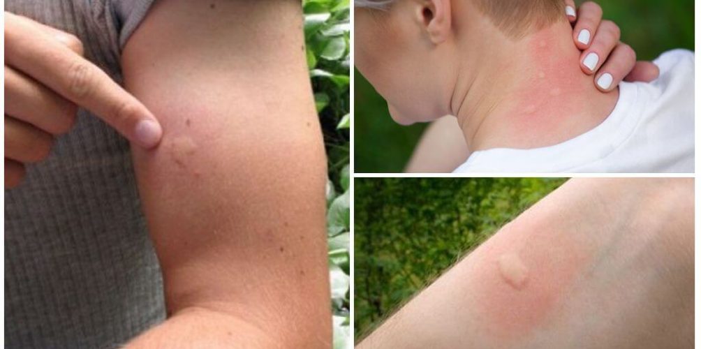 تزداد خلال الصيف.. هكذا تتخلصون من لدغات البعوض