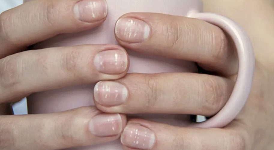 على الأظافر.. أعراض جديدة لكورونا