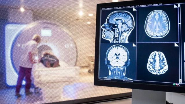 مدون طبي: دماغ الشخص الذي تعافى من كورونا قد يعمل بشكل أسوأ