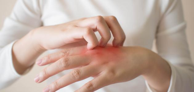 احذروها.. علامات على الجلد تدل على الإصابة بـ »أوميكرون »!