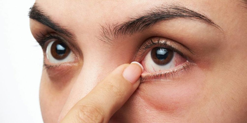 لا تجاهلوها.. علامة في العين قد تدل على الإصابة بسرطان الثدي!