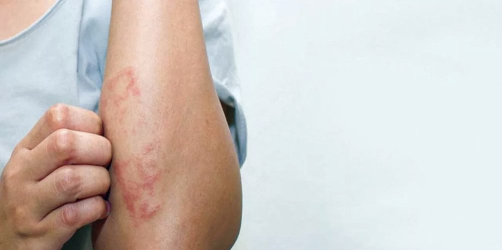 احذروها.. علامات مقلقة تدل على الإصابة بسرطان الدم!