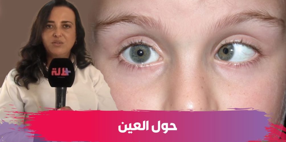 الحول.. طبيبة عيون تكشف عن أسبابه وأعراضه وطرق علاجه