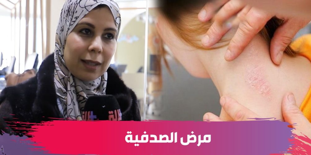 مرض الصدفية.. الدكتورة كوثر عناني تكشف أسبابه وأعراضه وطرق علاجه