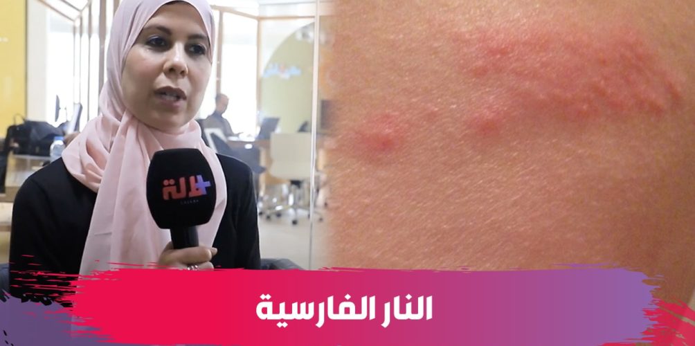مرض الزونا.. الدكتورة كوثر عناني تكشف أسبابه وأعراضه وطرق علاجه