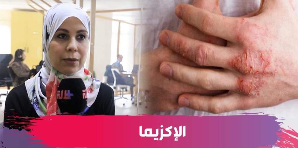 أعراضها وطرق علاجها.. الدكتورة كوثر عناني تشرح مرض الإكزيما    الإكزيما
