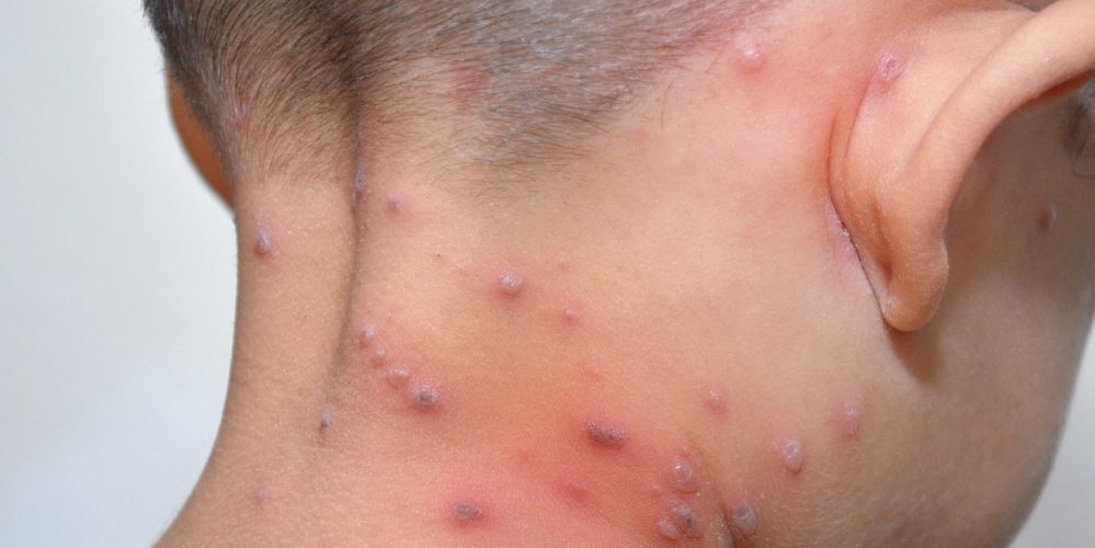 الوضع لا يبشر بالخير.. العالم يسجل أزيد من 700 حالة إصابة مؤكدة بجدري القردة