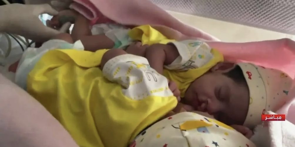 شارك في العملية 28 طبيبا واختصاصيا.. نجاح عملية جراحية لفصل توأم سيامي (صور)