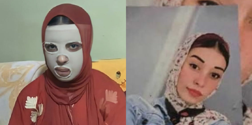 لرفضها الارتباط به.. شاب ينتقم من فتاة بطريقة مروعة