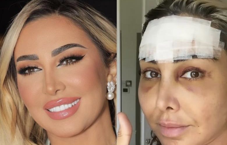 صغراتها بـ20 عام.. جويل تخضع لجراحة تجميلية جديدة