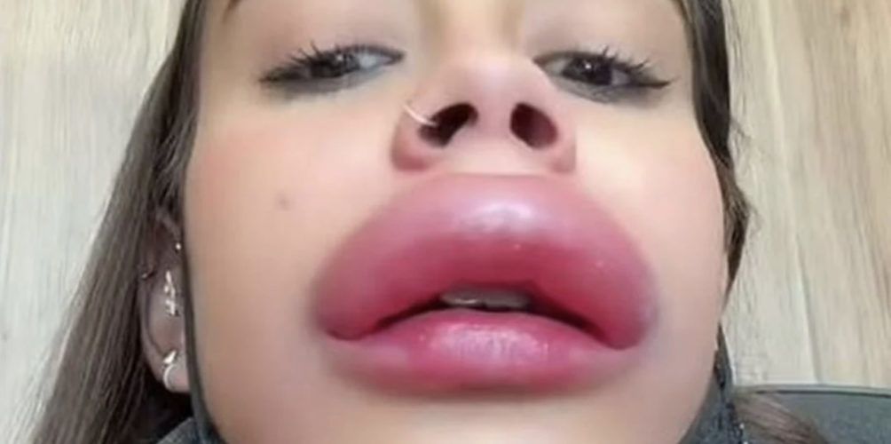 فكري مرتين قبل أي إجراء تجميلي!.. نتيجة صادمة لشابة بعد حقن الفيلر