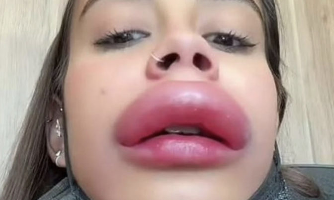 فكري مرتين قبل أي إجراء تجميلي!.. نتيجة صادمة لشابة بعد حقن الفيلر